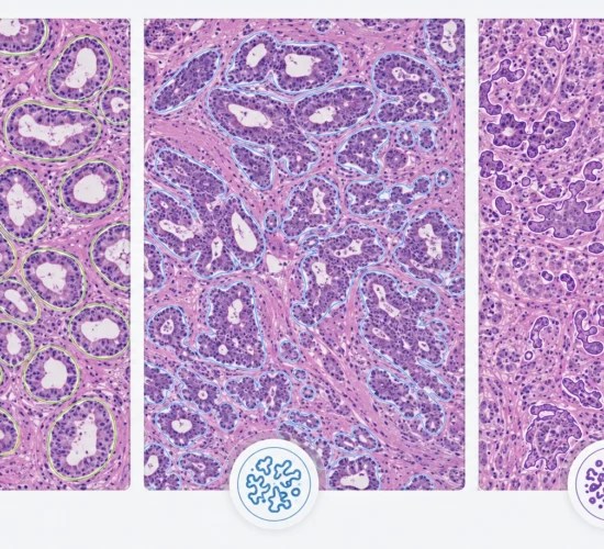 Tumour Grading