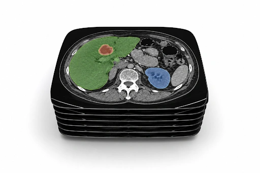 Stacked CT scan slices with colour-coded annotations highlighting anatomical structures and a lesion for radiology AI training.