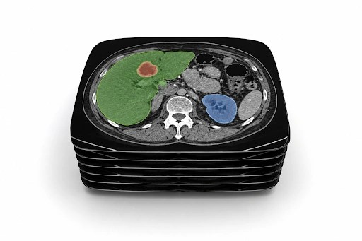 Stacked CT scan slices with colour-coded annotations highlighting anatomical structures and a lesion for radiology AI training.